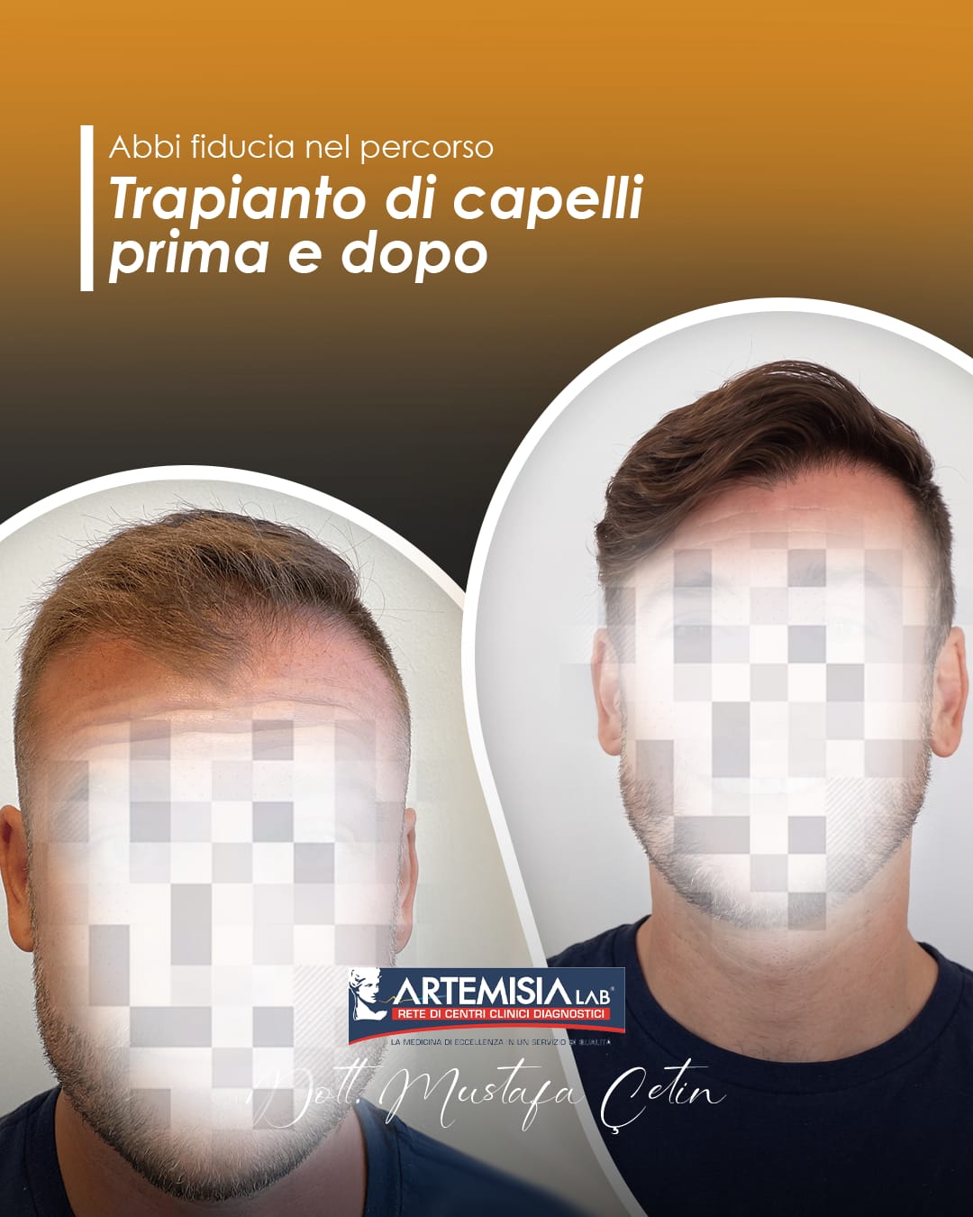 Trapianto di capelli prima e dopo — caso 5, volto oscurato