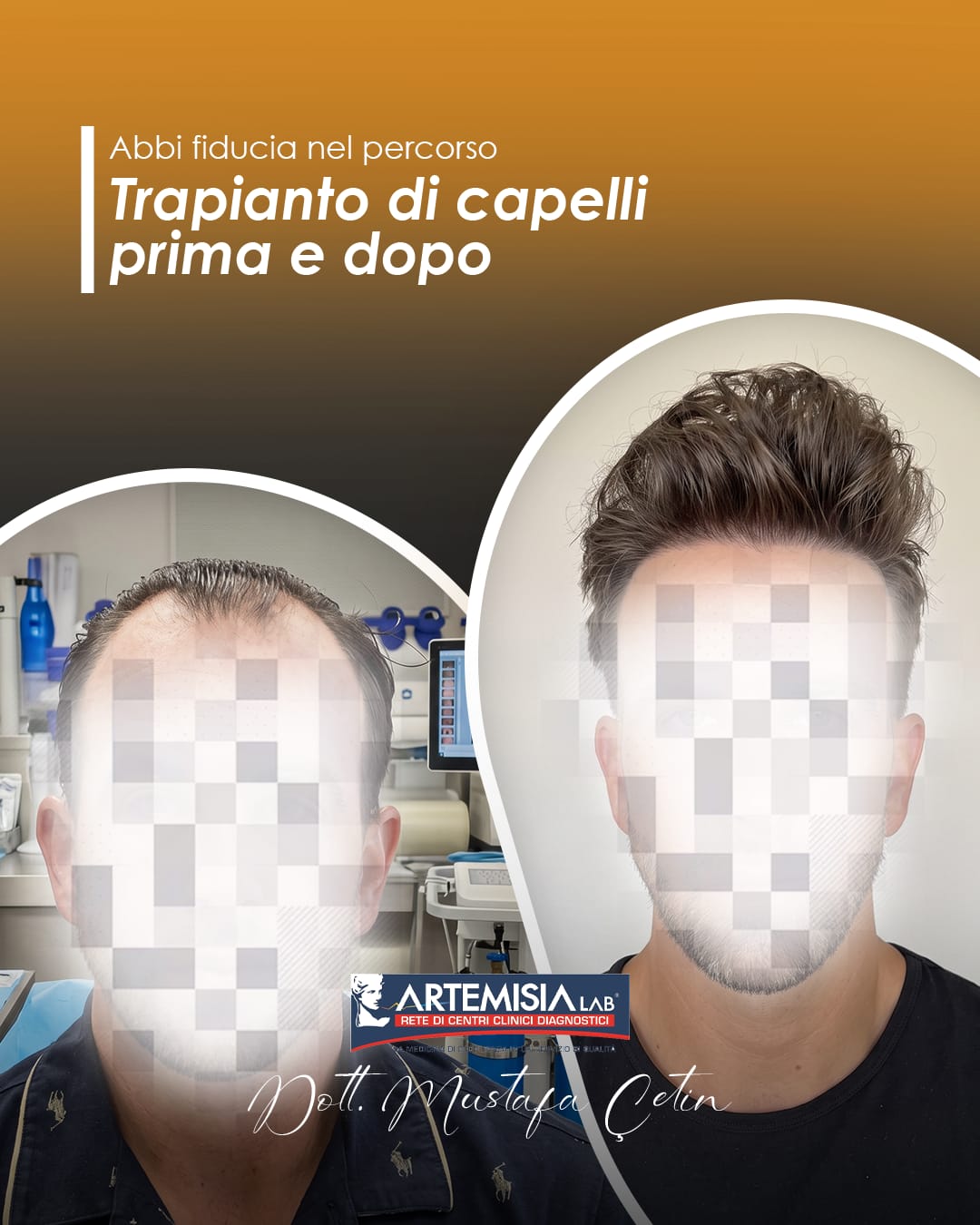 Trapianto di capelli prima e dopo — caso 6, volto oscurato