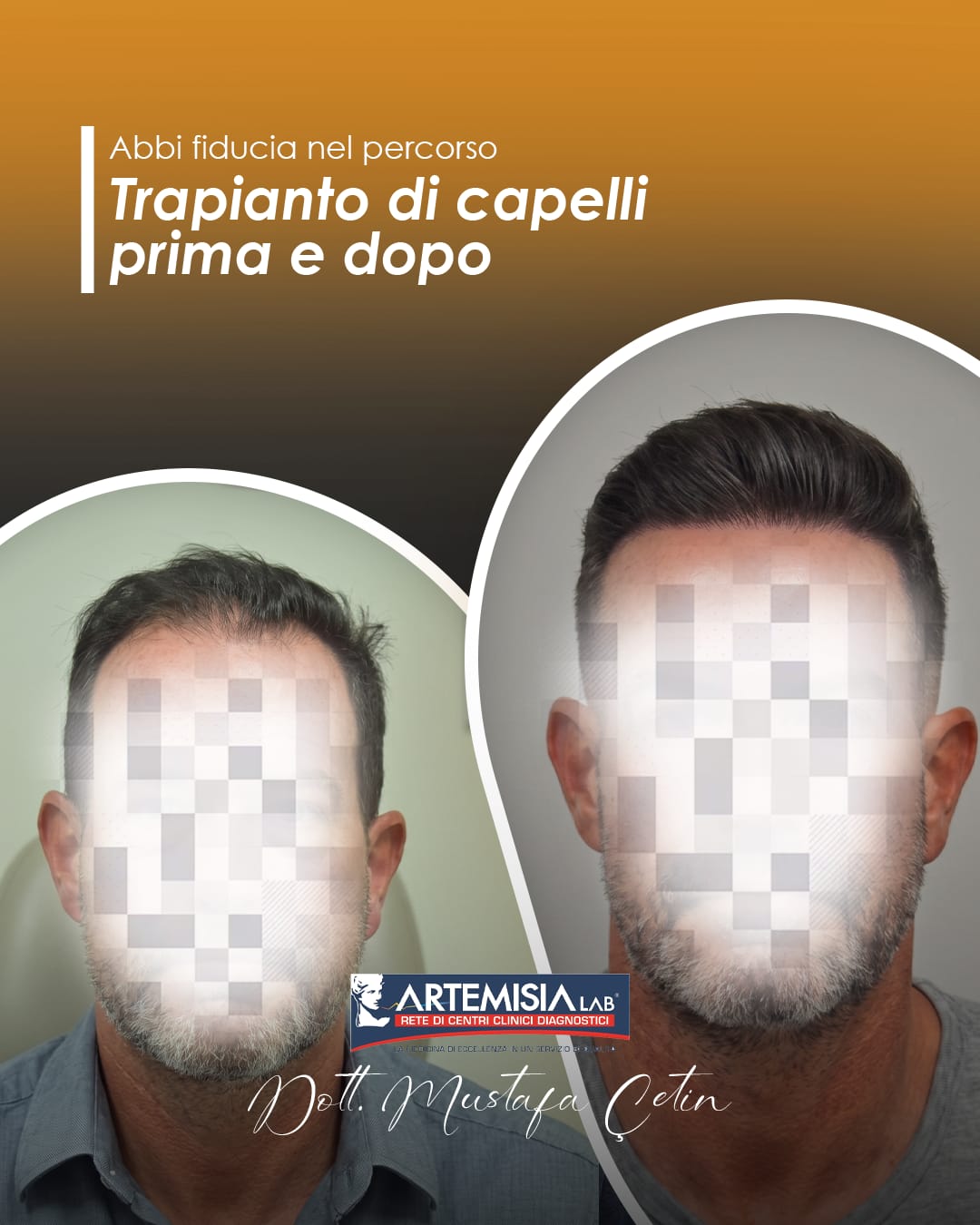 Trapianto di capelli prima e dopo — caso 7, volto oscurato