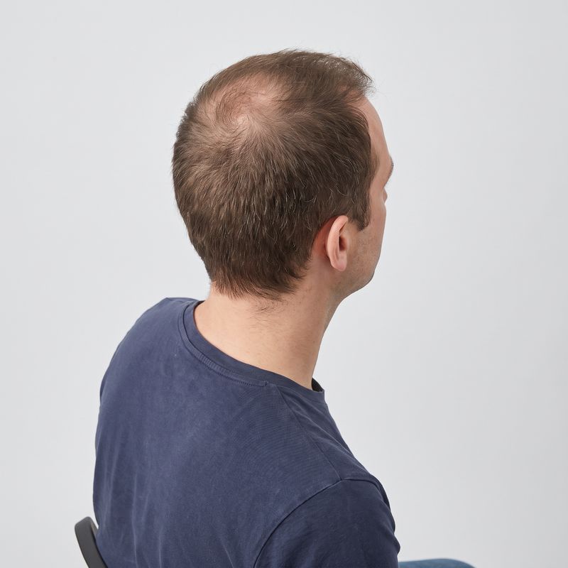 Cuoio capelluto da sostenere