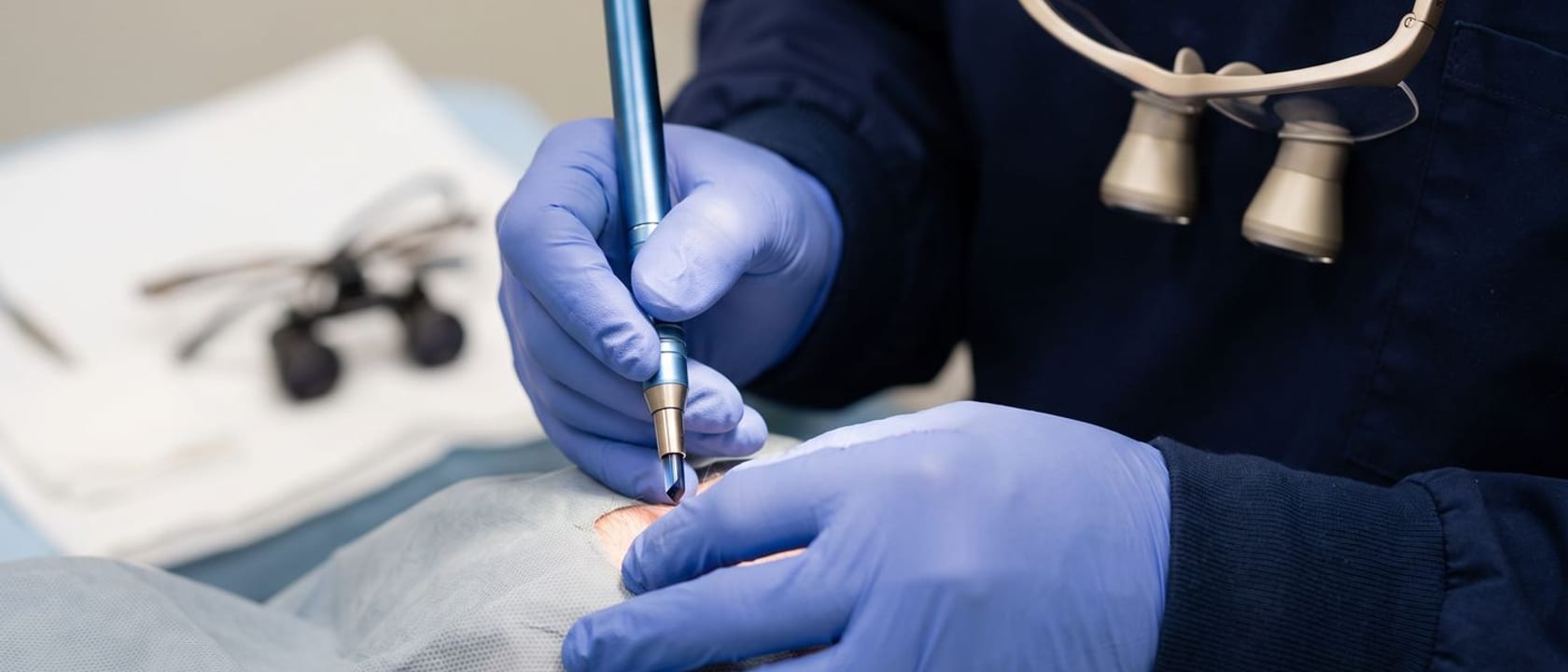 Trapianto di capelli FUE: come funziona, recupero e come scegliere il medico
