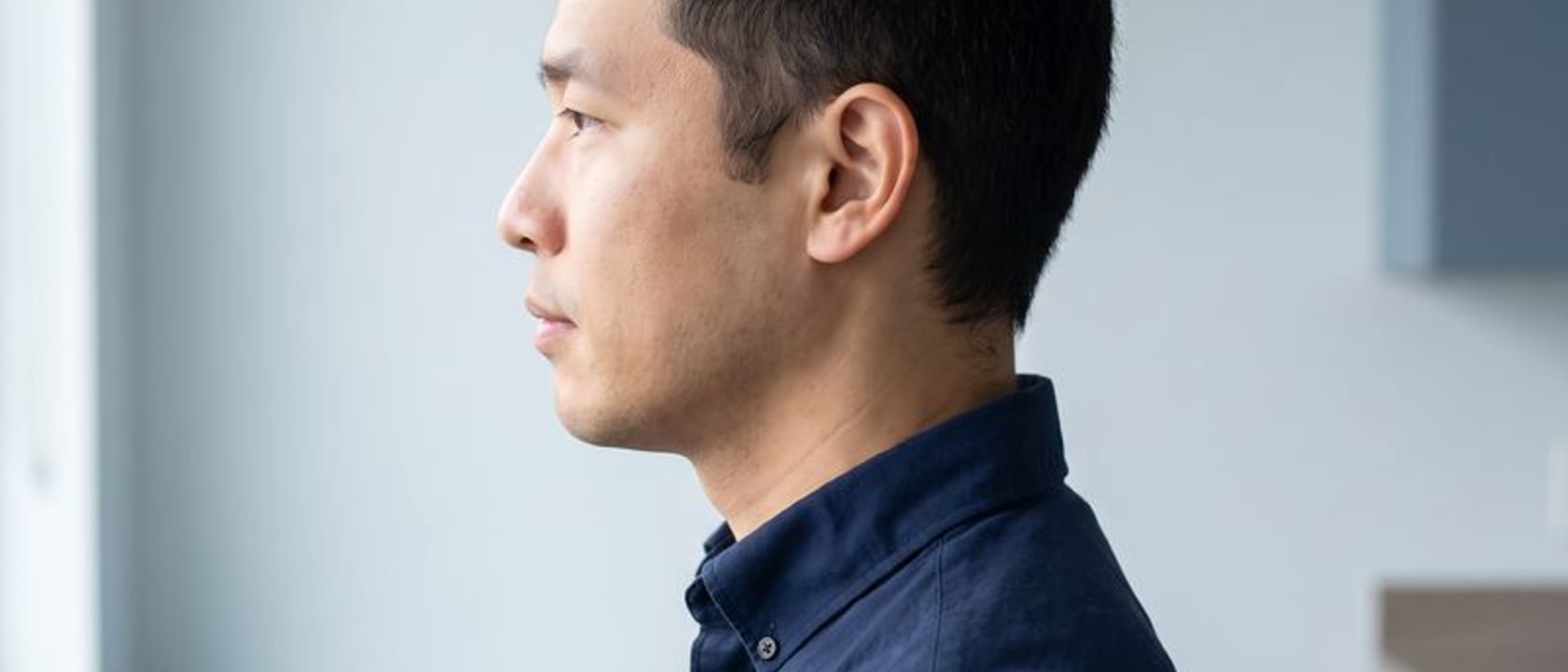 Trapianto di capelli per la stempiatura: quando ha senso e come si disegna la linea frontale