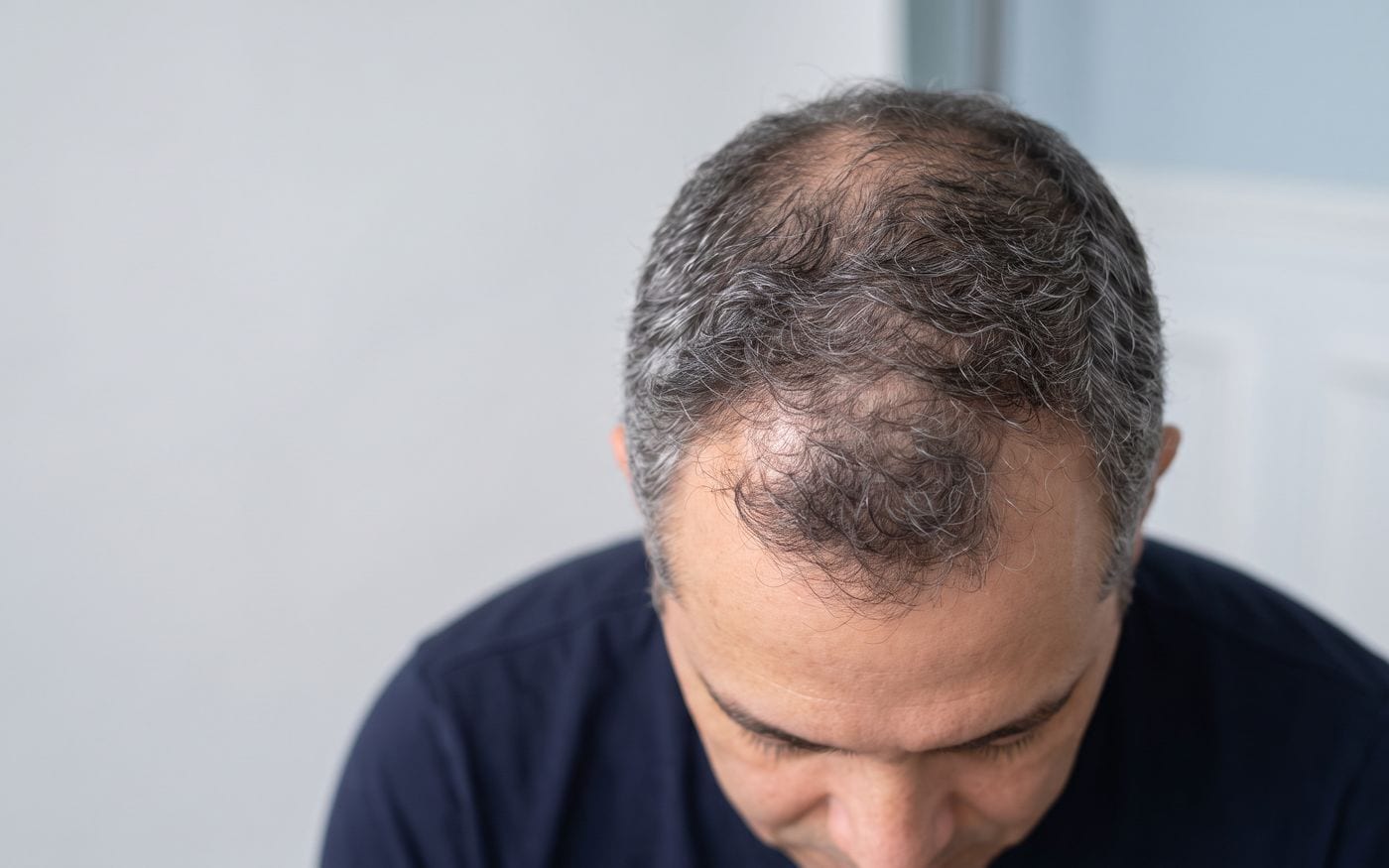 Stempiatura frontale valutata prima di un trapianto di capelli