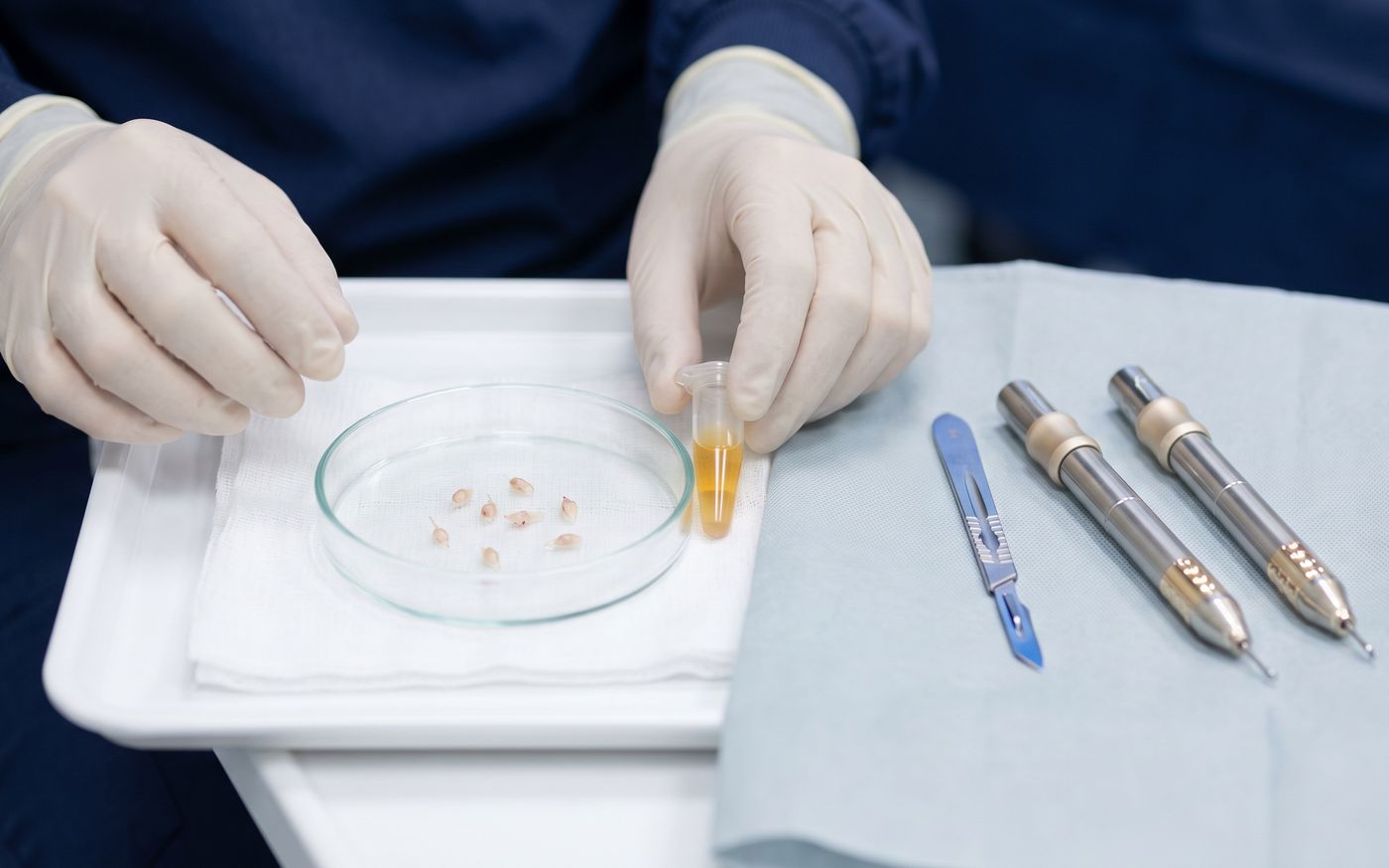 Provetta di plasma PRP, innesti follicolari e strumenti per il trapianto su un vassoio sterile